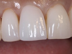 ノナカデンタルクリニック/右上の前歯の治療